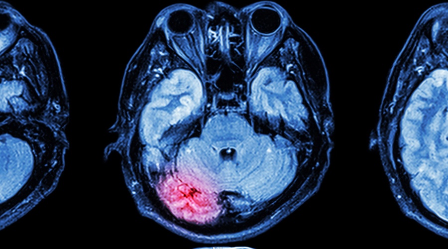 What Is An Anoxic Brain Injury And How Do You Treat It