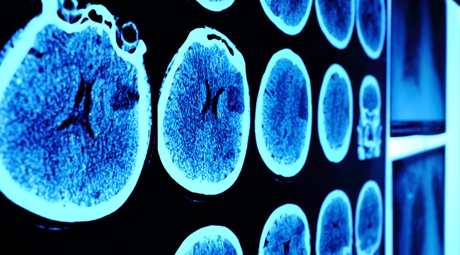 WHAT CAN HELP ME RECOVER FROM A CONCUSSION?