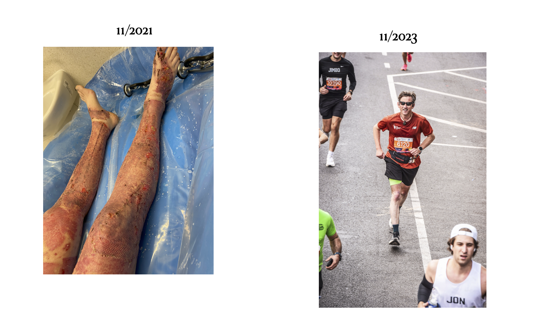 bi-laterl lower extremity burn healed before and after HBOT