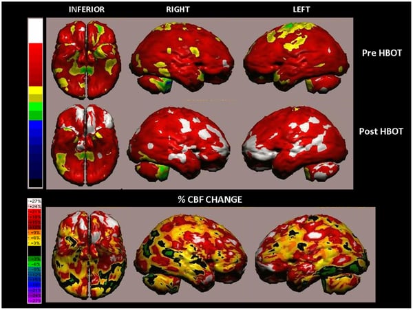 Volume rendered Brain SPECT Perfusion Map