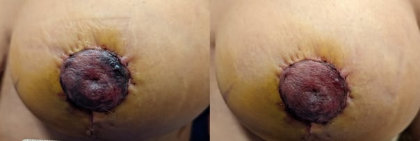 Post-Breast-Reconstruction-5-22