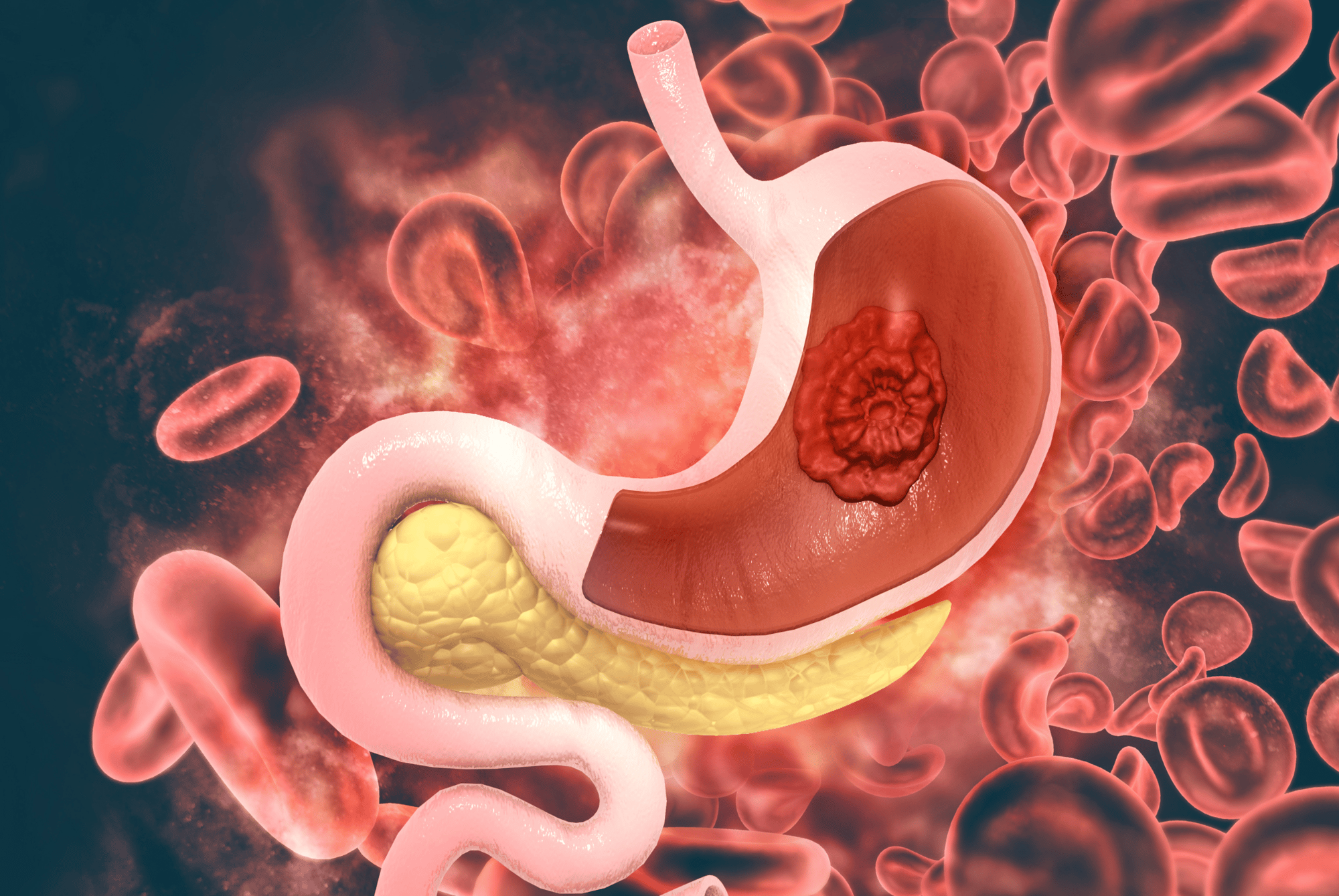 Gastric cancer and tumor, stomach cancer.