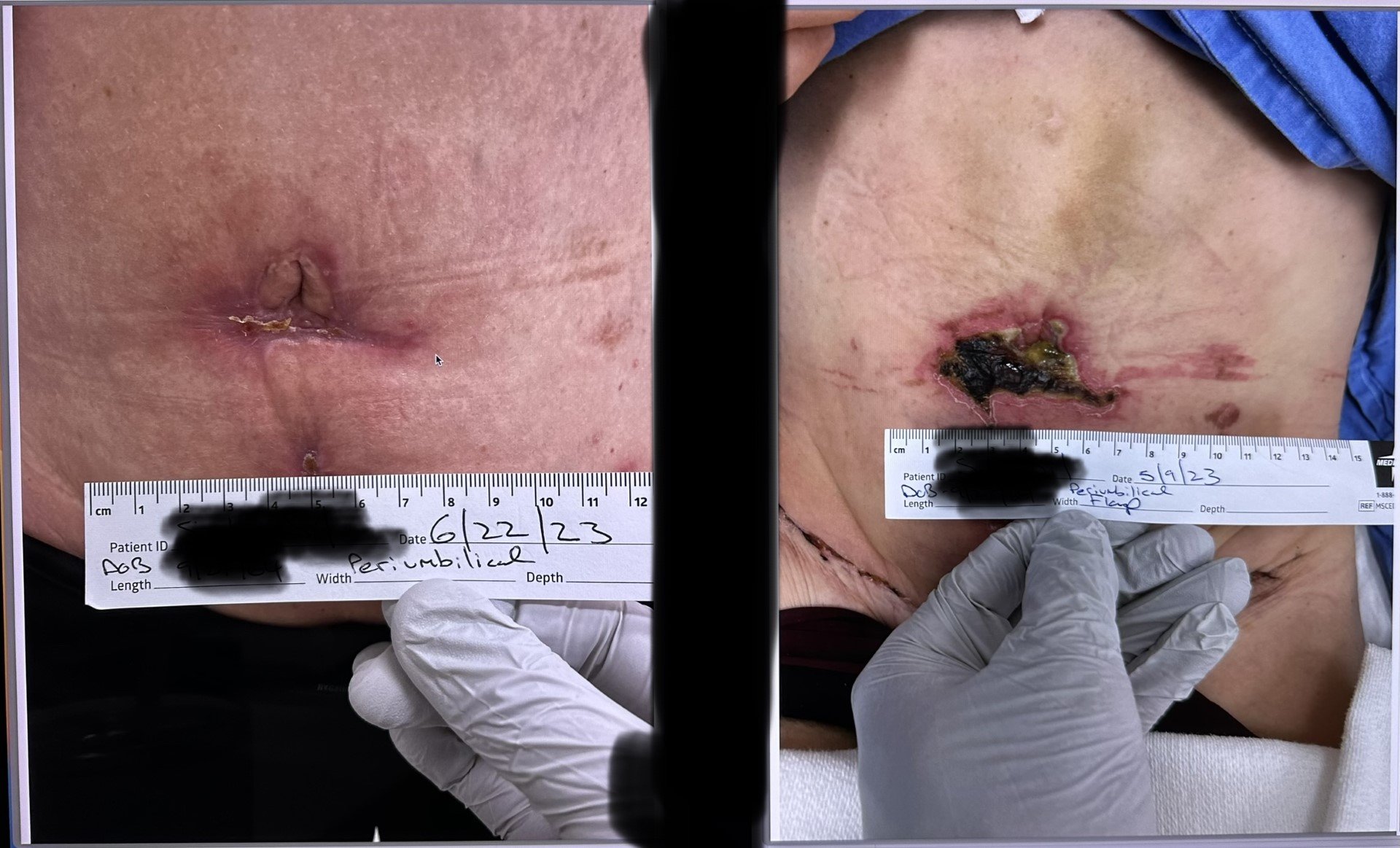 Case Study: Failed Flap after 