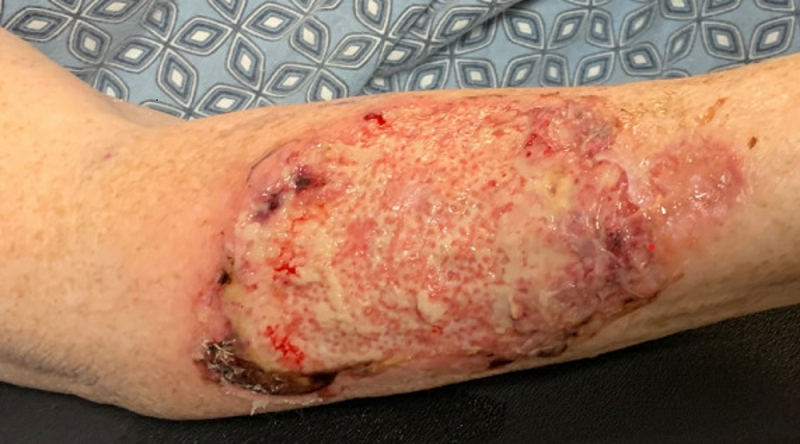 New Published Case Report: HBOT as treatment for Pyoderma Gangrenosum