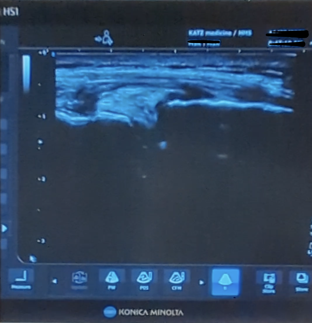 Knee meniscus under an ultrasound, while stressing the knee, we captured major disruption in the meniscus.