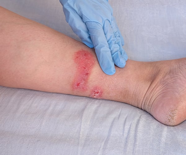 A closeup of a wound on the back of a person's leg.
